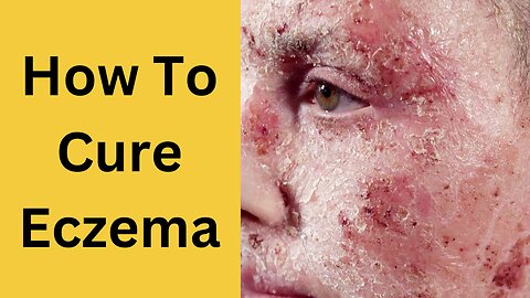 How To Cure Eczema and itchy skin