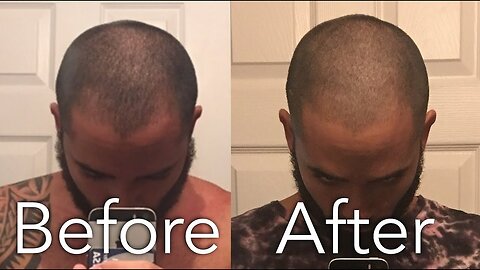 How I Stopped My Hair loss Naturally