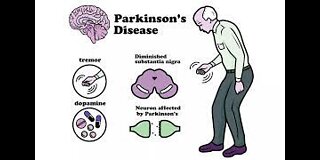 Treating Parkinson's disease with diet.