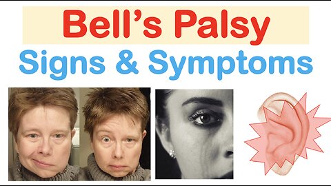 Bell’s Palsy (Facial Paralysis) Signs & Symptoms (& Why They Occur)