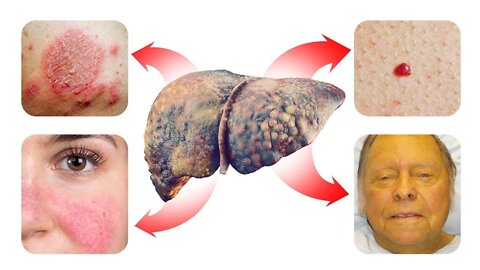 15 SKIN Signs that Reveal Your Liver is in Trouble