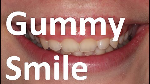 Orthotropics Treatment of Gummy Smile (Excessive Gingival Display) by Prof John Mew