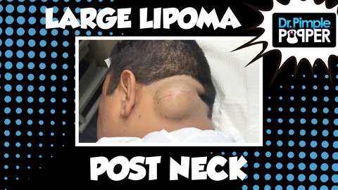 El Diablo Nino Lipoma