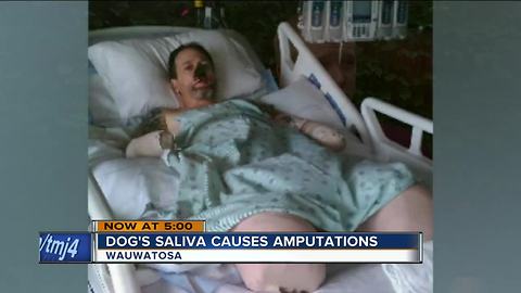 West Bend man loses hands and feet from dog saliva