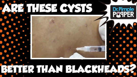 Dr. Pimple Popper: BETTER than BLACKHEADS?!