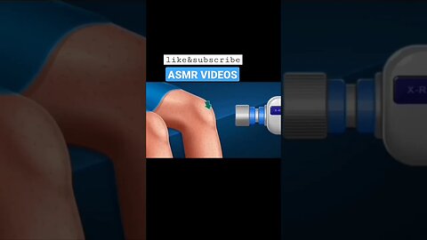 ASMR || Ankle Knee || Fracture treatment|| #shorts