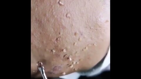 Remoção de Cravos e Espinhas - Remove Squeezing Blackheads and Pimples - Just Relax | Apenas Relaxe