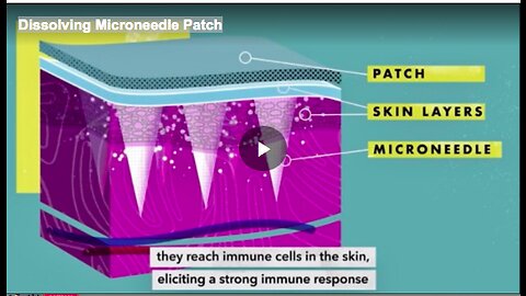 Dissolving Microneedle Patch