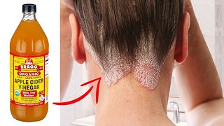 Get Rid Of Hair Fungus With 10 Simple Home Remedies | Health and Nutrition Channel