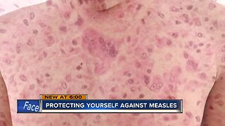 Doctors: Vaccinations could have prevented return of measles