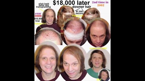 My $18,000 in hair transplants. had 1,400 in 2000, 1,400 in 2002