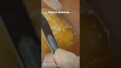 Callus Yum