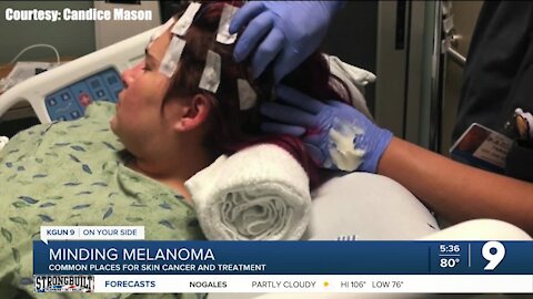 Minding Melanoma: Surgery and treatment