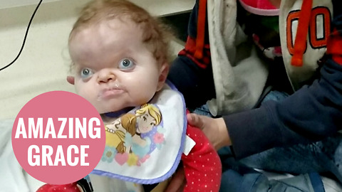 Toddler with rare condition defies doctors to sit up for the first time