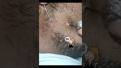 Giant black head removal