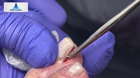 INGROWN TOENAIL REMOVAL - UNHA ENCRAVADA - PODOLOGY