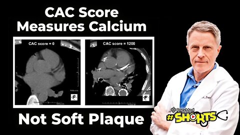 #SHORTS CAC Score Measures Calcium not Soft Plaque, but it is Still useful