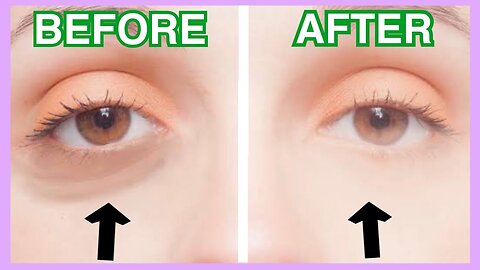 Massage to Remove Dark Circles Under Eyes & Sunken Eyes in 3 mins!