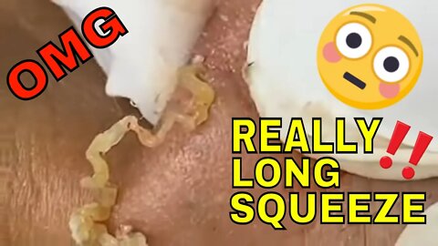 Surprisingly long blackhead 😳🪱 #blackheadremoval #blackhead #blackheads #blackheadheadsextraction