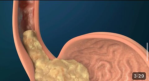 How to prevent stomach acidity or heartburn leading to gastroesophageal Reflux Disease