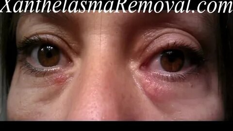 XanthRemover PRof, the professional option for Xanthelasma Removal