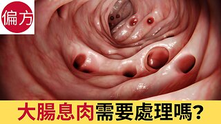 大腸息肉需要處理嗎?