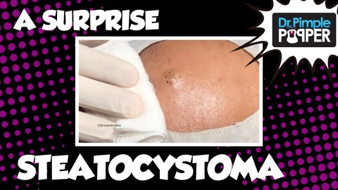 A Surprise Steatocystoma!