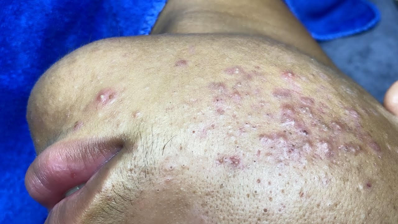 Big Cystic Acne Blackheads Extraction Blackheads & Milia, Whiteheads
