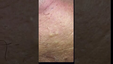 Remoção de Cravos e Espinhas - Remove Squeezing Blackheads and Pimples - Just Relax | Apenas Relaxe