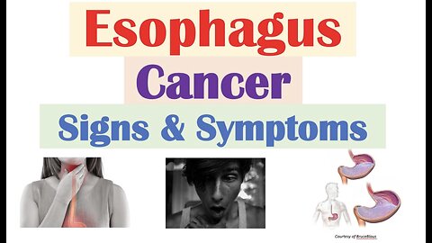 Esophageal Cancer Signs & Symptoms (& Why They Occur)