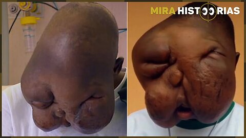 Lembra do homem com tumor estranho que desalinhou seu rosto? Ele se recuperou e parece outra pessoa