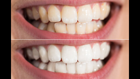 How to Whiten Teeth Naturally (INSTANTLY 100%)