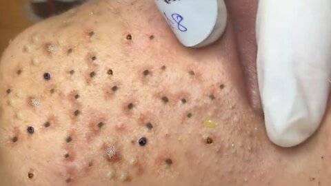 Removing Acne and Blackheads Treatment, #29