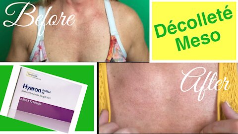 Hyaron in My Chest for Skin Health | Wrinkle Reduction