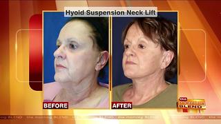 Reversing the Signs of an Aging Neck