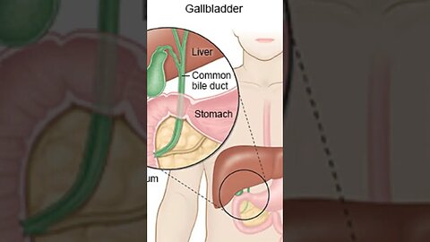 Cholecystitis short Urdu video