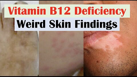 Vitamin B12 Deficiency Weird Skin Findings (& Hair and Nails)