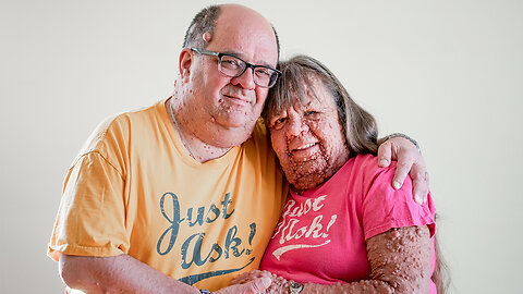 Husband & Wife With Thousands Of Tumours: BORN DIFFERENT