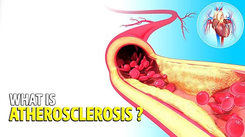 What is Atherosclerosis