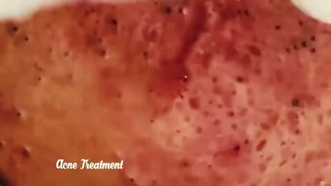 Satisfactory Video Blackhead Removal On Skin For Relaxation