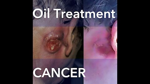 Episode 178: A Massive Infected Cancerous Tumor Behind His Ear Cleared With Cannabis Oil