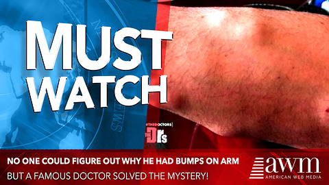 For 20 Years No One Could Figure Out Why He Had Bumps On Arm, Doctor Finally Solves Mystery