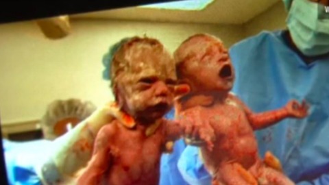 Twins With Rare Condition Born Holding Hands