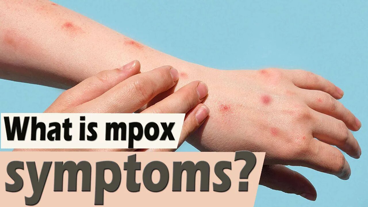 What Is Mpox Symptoms What Causes Mpox Positive