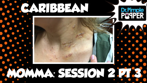 Caribbean Momma and her Steatocystomas: Session Two, Part Three