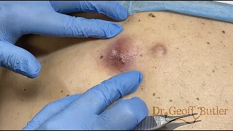 Drainage of an infected Cyst