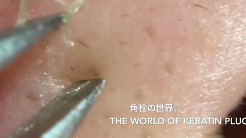 Removal / extraction of blackheads and pimples. Satisfying videos to relax!