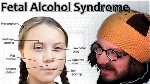 Sam Hyde on Fetal Alcohol Syndrome