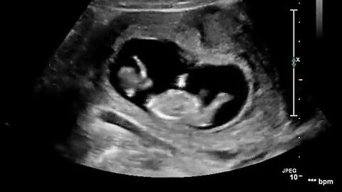 Ultrasound Shows Baby Jumping in the Womb