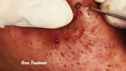 Satisfactory Video Blackhead Removal For Relaxation | 2022 Videos